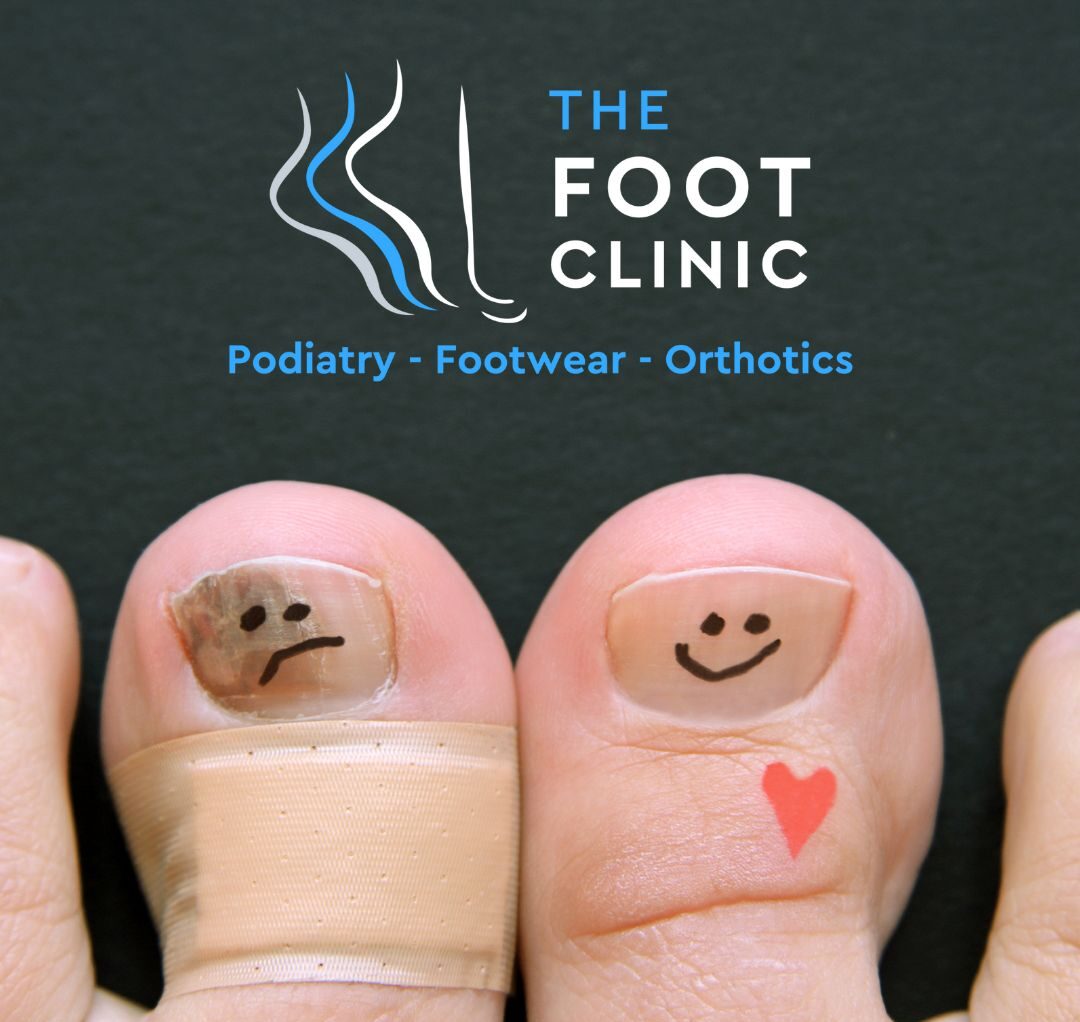 Ingrown Toenails › The Foot Clinics Wagga And Wodonga